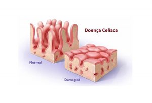 Doença Celíaca O que é Veja as causas sintomas e tratamento