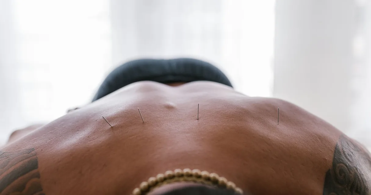 Acupuntura pelo SUS: agulhas de acupuntura aplicadas nas costas de um paciente deitado