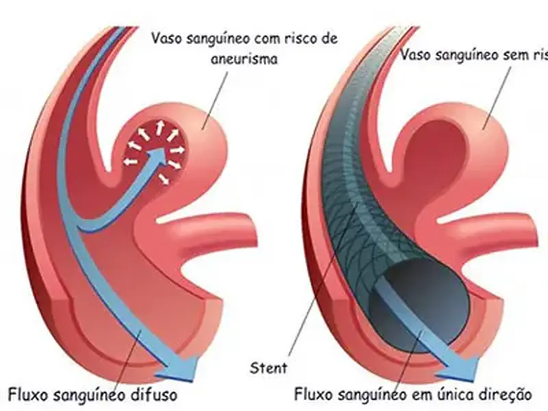 Aneurisma: Uma doença silenciosa