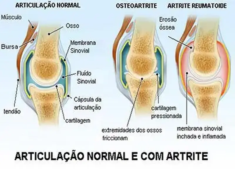 Artrite: Doença de idoso?