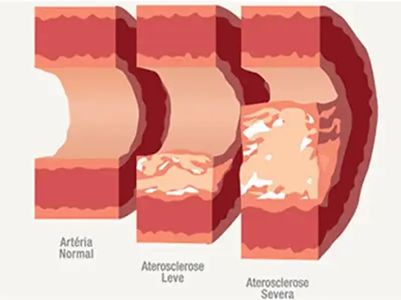 Aterosclerose: O perigo do acúmulo do colesterol