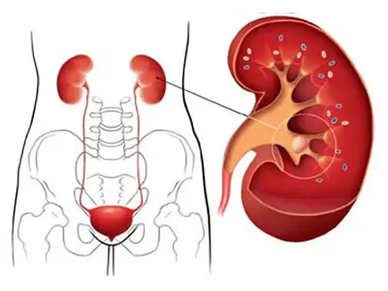 Cálculo renal