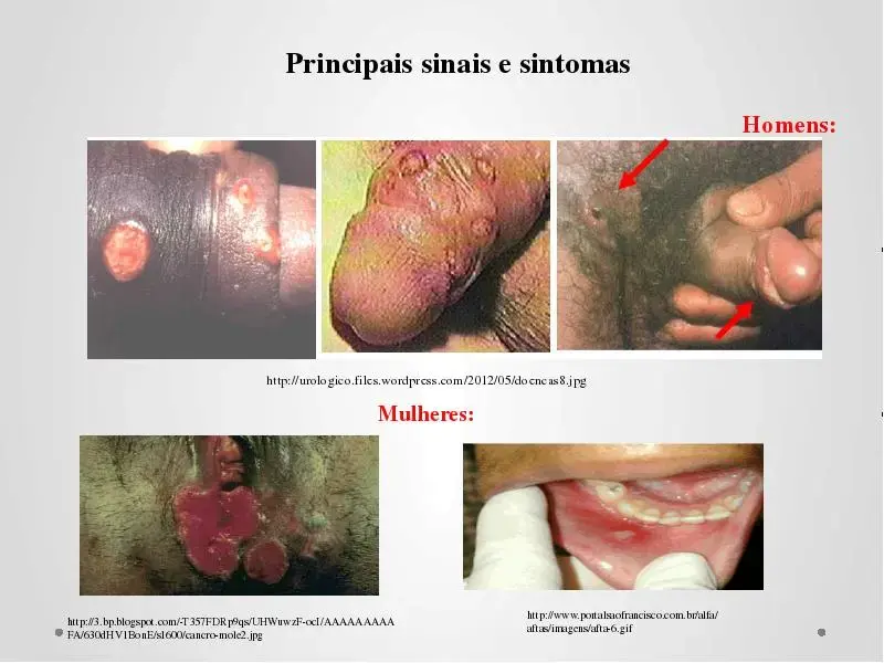 Cancro mole: O risco de não usar camisinha