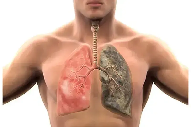 Enfisema pulmonar: o presente do cigarro