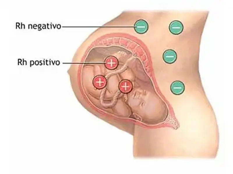 Eritroblastose fetal