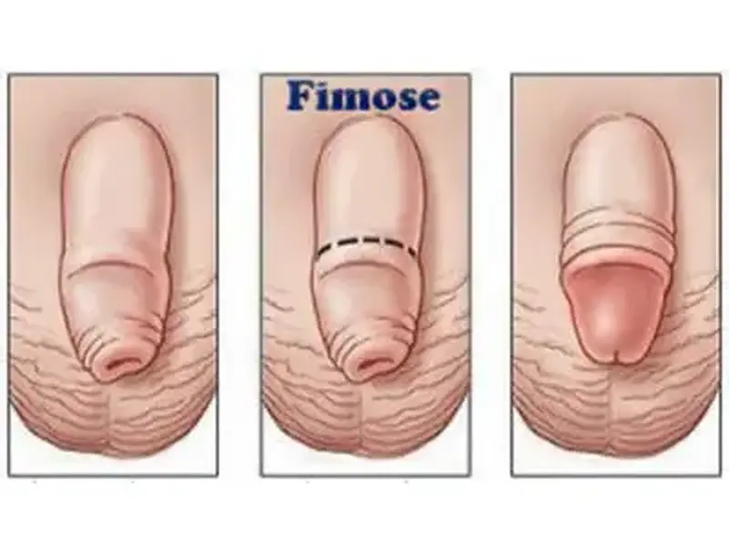 Fimose - Como é a Cirurgia? As Melhores Pomadas, Sintomas, Imagens!