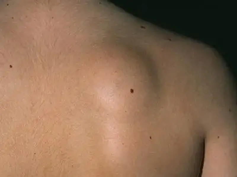 Lipoma: Tumores benignos que ficam embaixo da pele
