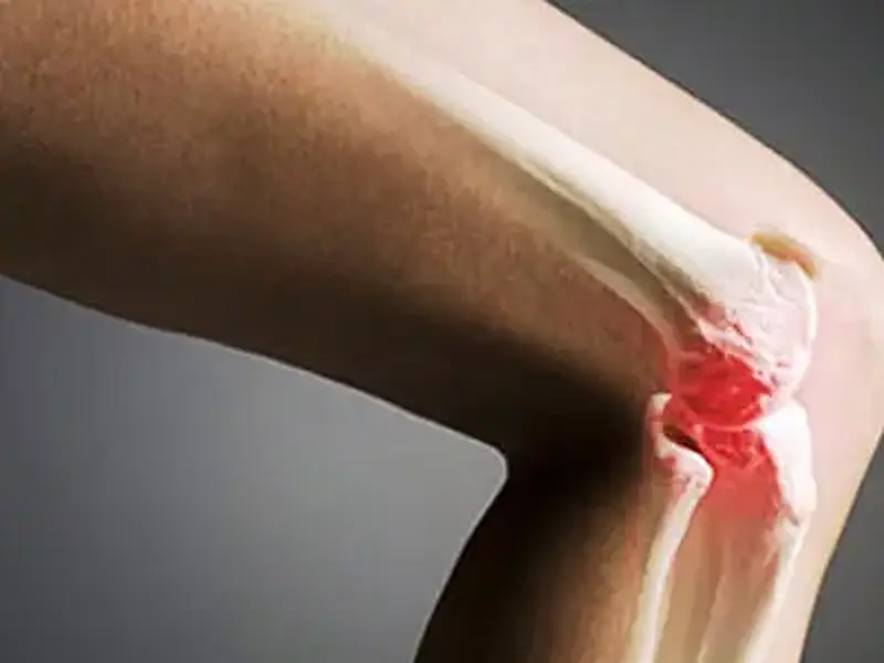 Osteomielite: O que é, quais as causas e forma de tratamento
