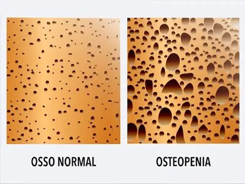 Osteopenia: A condição de perda de massa óssea no corpo