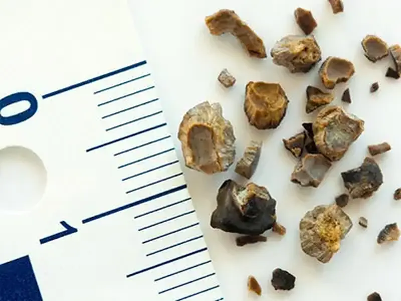 Pedra nos rins: Uma dor insuportável