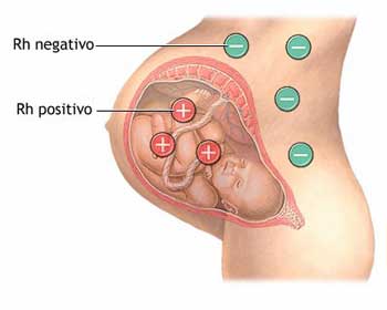 Eritroblastose fetal