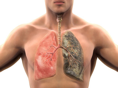 enfisema pulmonar