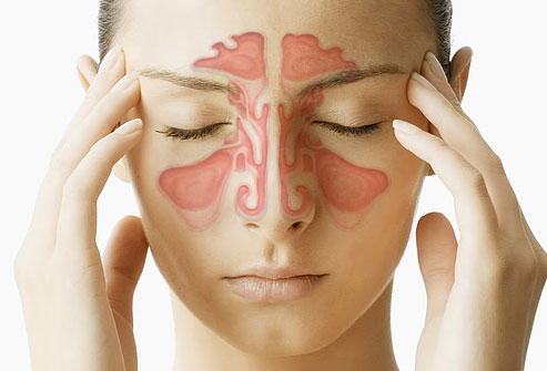 sintomas de sinusite