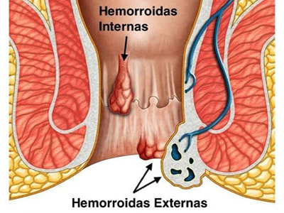 hemorroidas externas