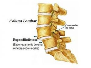 Retrolistese Cervical Tem Cura? Tratamento fisioterapêutico funciona?