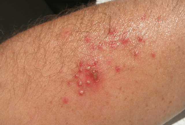 Infecção Bacteriana na Pele