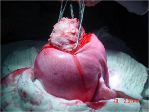 mioma uterino foto 2