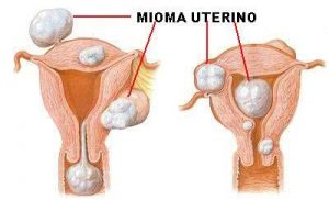 mioma uterino tratamento